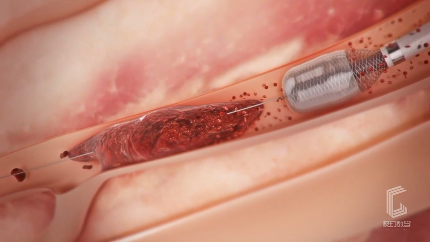 心脏支架手术技术医疗动画展示片