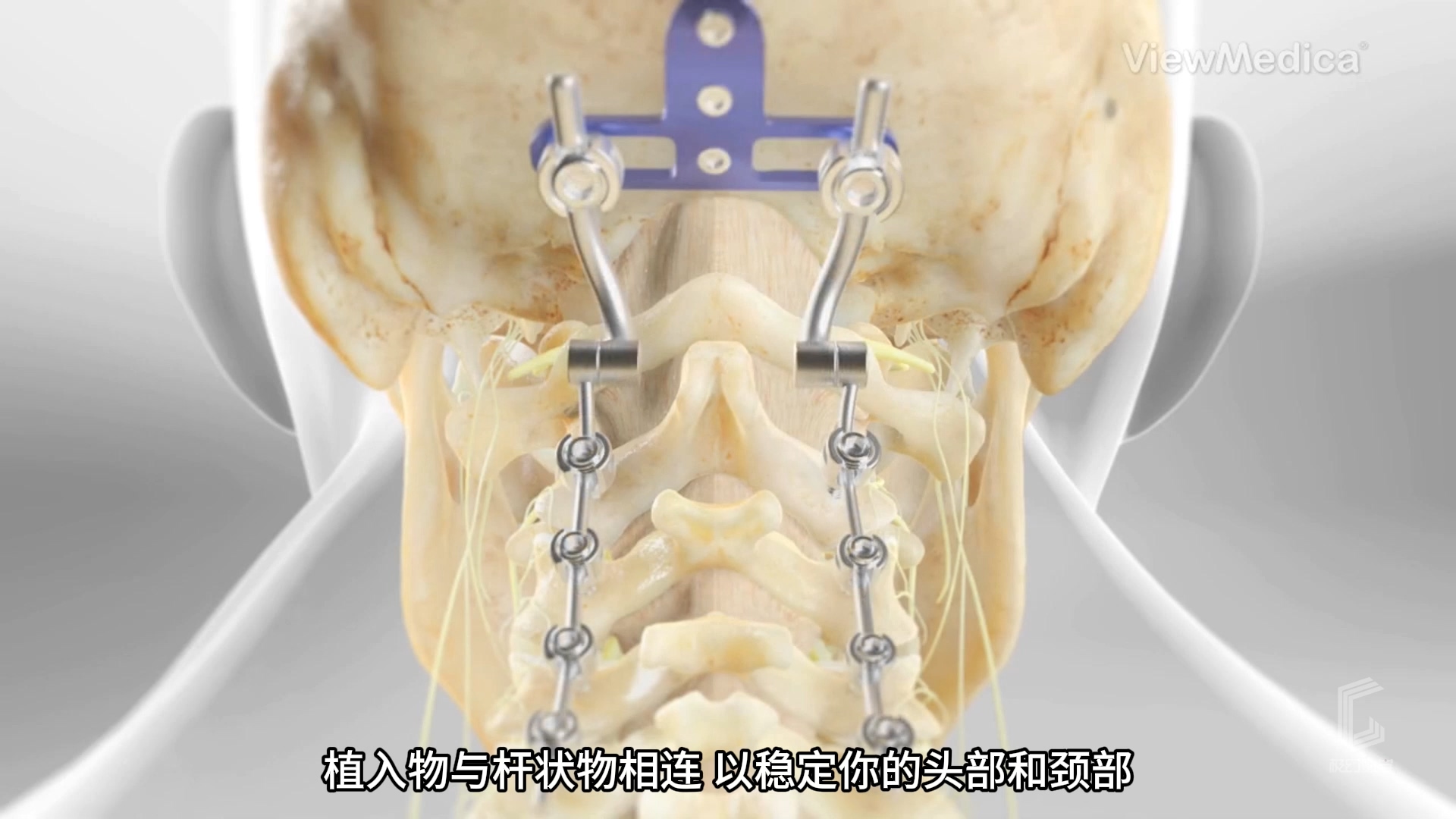 枕颈固定-医疗3D动画视频
