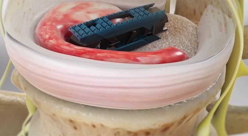 腰椎椎间融合器植入器械结构拆解三维动画